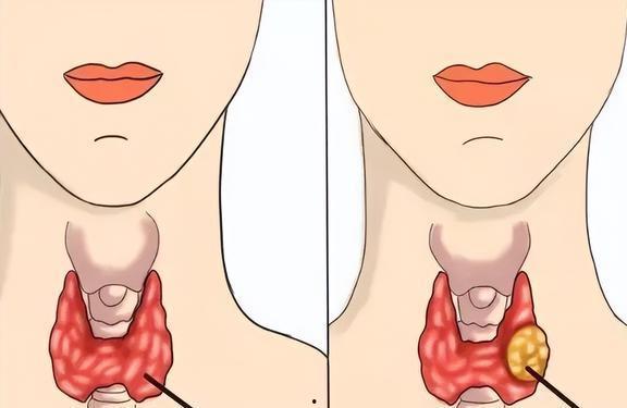 甲状腺触诊视频,视频教学带你轻松掌握